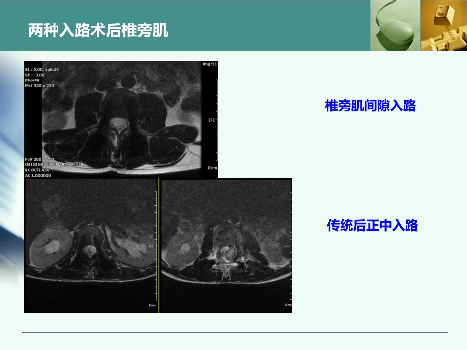 最全胸腰椎椎弓根置钉技术_第10页