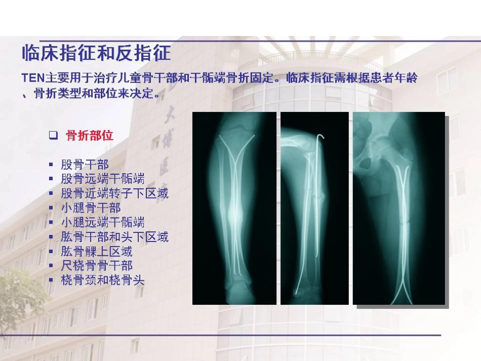 弹性髓内钉治疗儿童骨折操作技巧_第5页