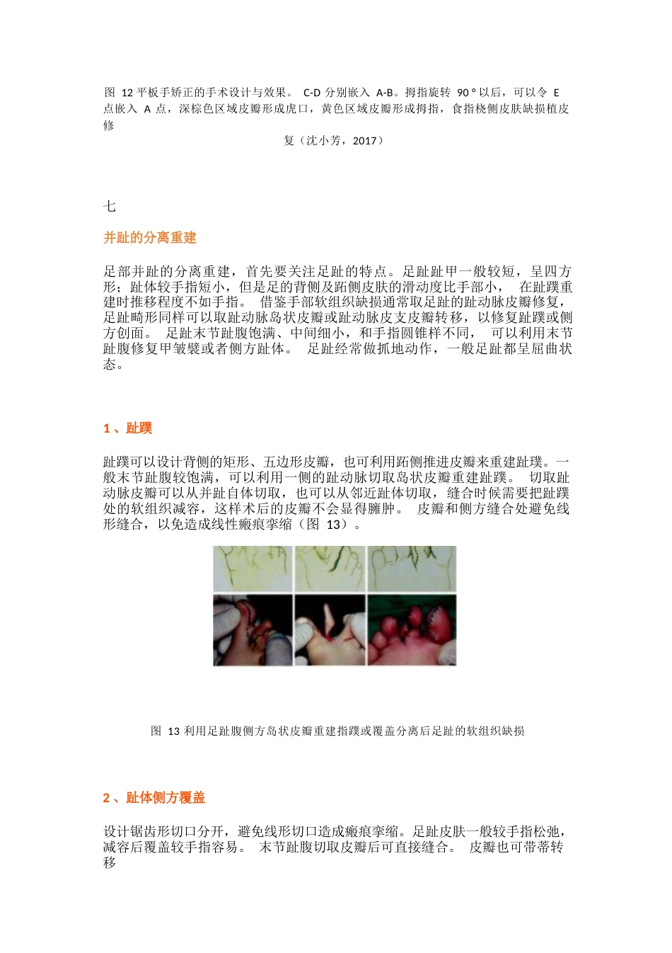 先天性并指畸形诊疗专家共识_第14页