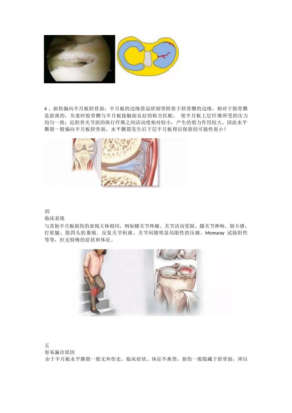 半月板水平撕裂的临床诊治技巧_第3页