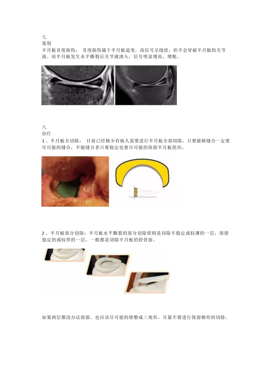 半月板水平撕裂的临床诊治技巧_第5页