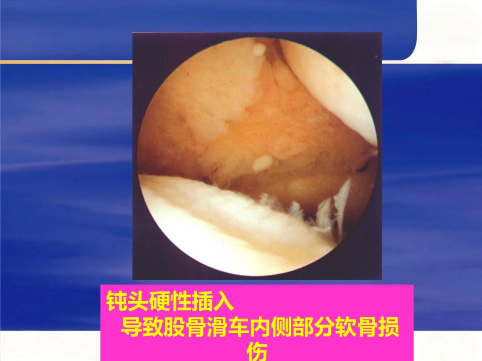 膝关节关节镜手术并发症_第9页