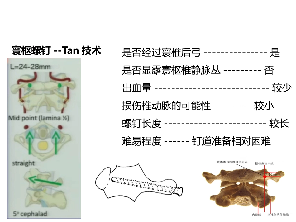 上颈椎后路内固定技术- 复件_第10页