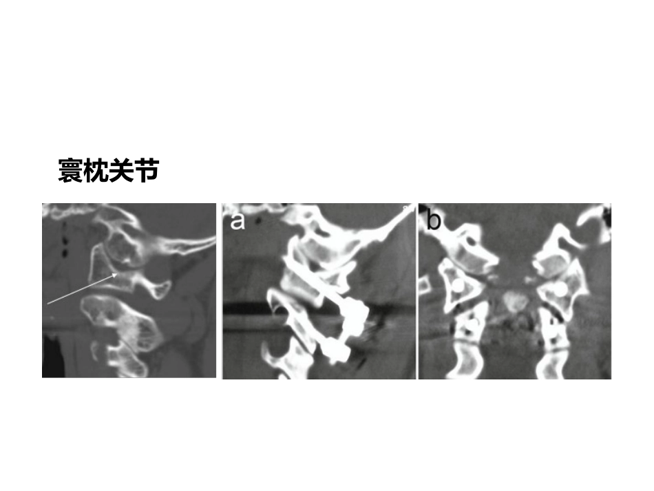 上颈椎后路内固定技术- 复件_第15页