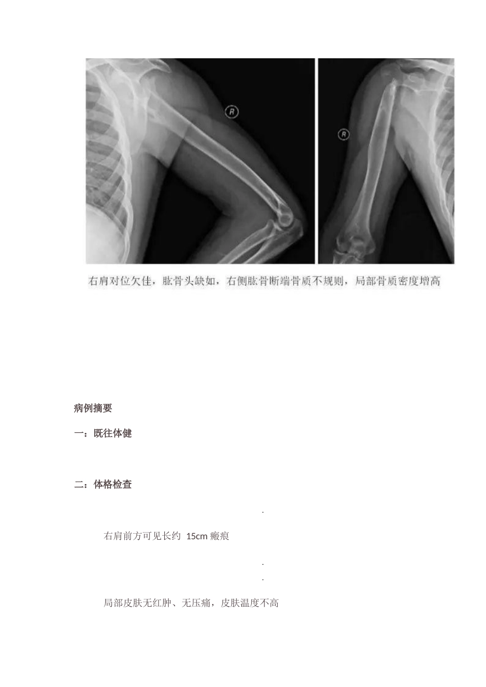 肩关节反向假体置换术技巧_第6页