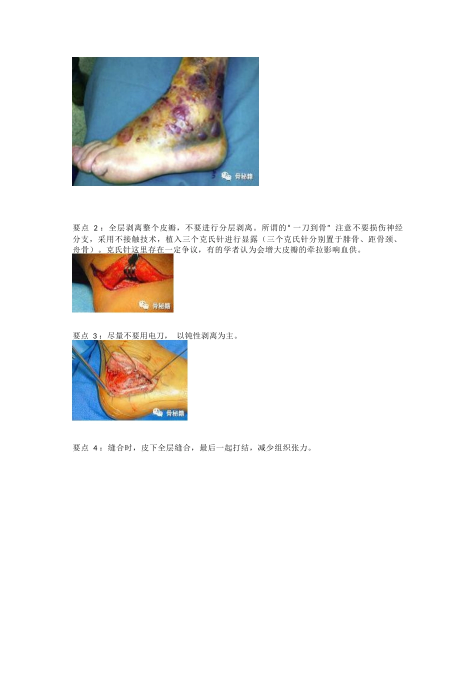 跟骨骨折的切口与缝合技巧_第4页