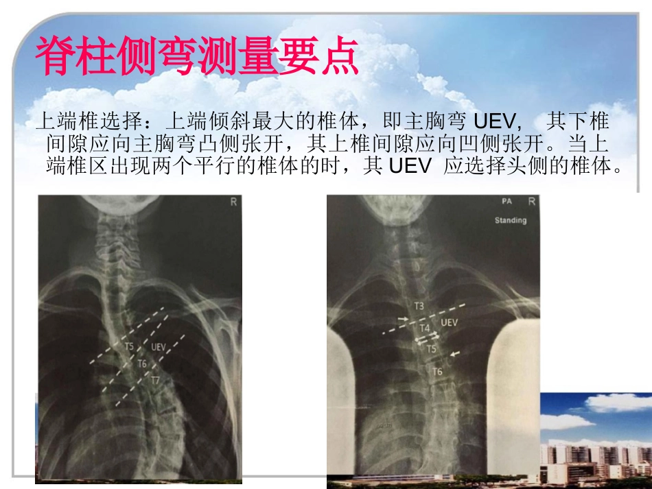 脊柱侧弯的诊断及治疗_第11页