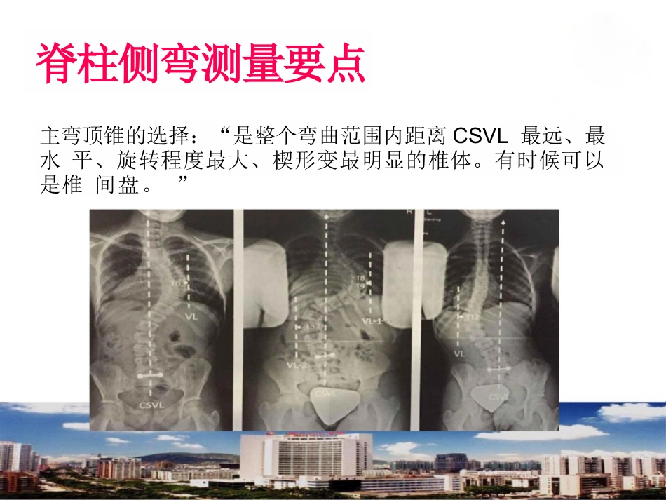脊柱侧弯的诊断及治疗_第13页