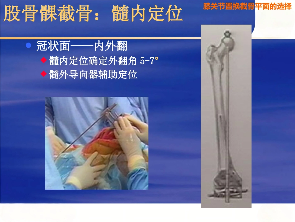 膝关节置换截骨面的决定_第10页