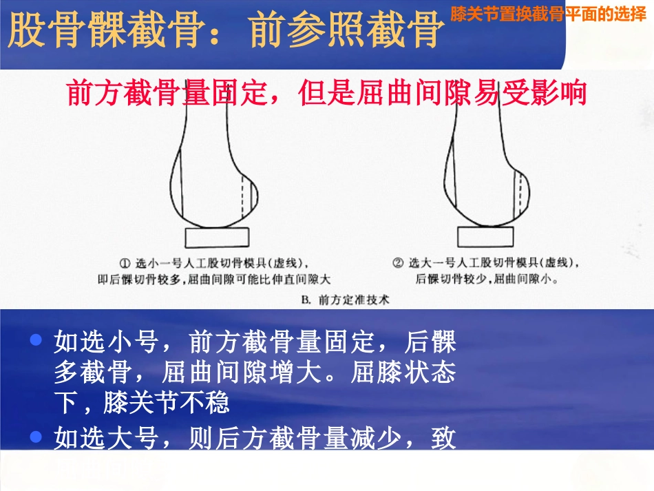 膝关节置换截骨面的决定_第14页