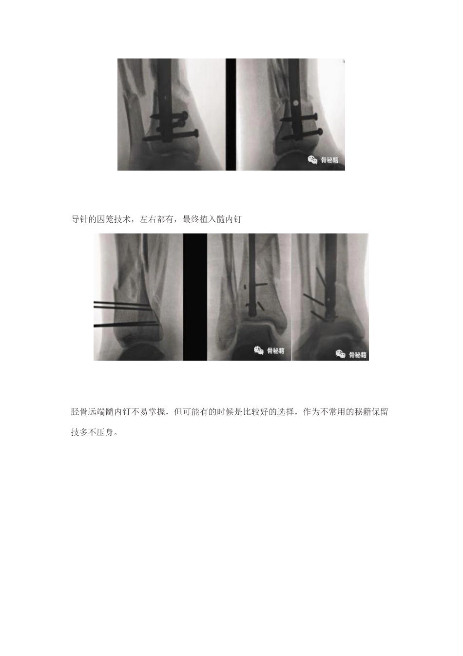 胫骨远端骨折髓内钉固定技巧_第15页