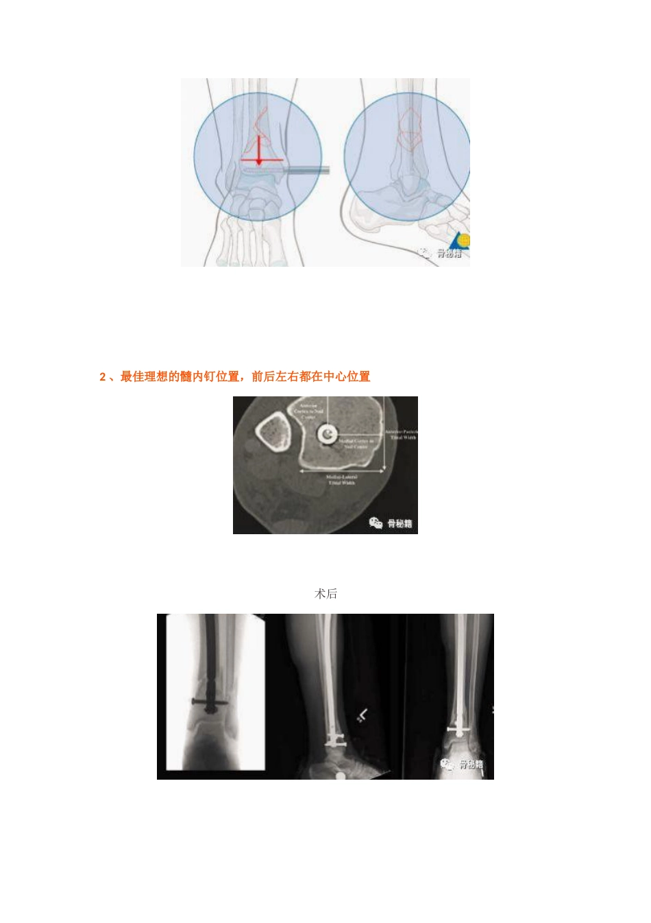 胫骨远端骨折髓内钉固定技巧_第6页
