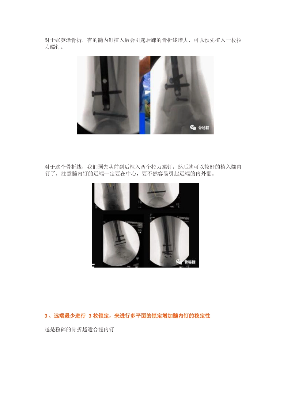 胫骨远端骨折髓内钉固定技巧_第7页