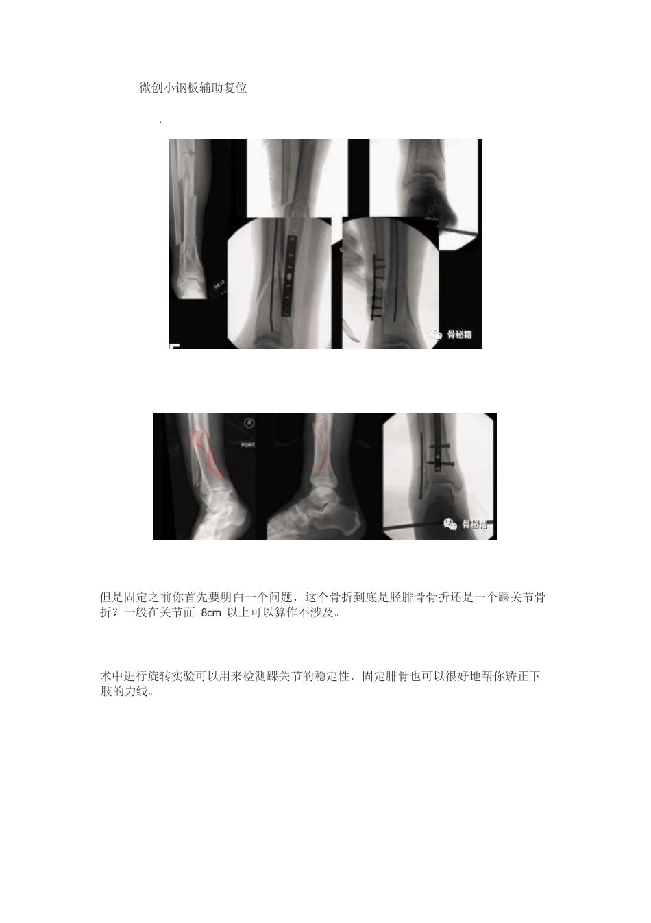 胫骨远端骨折髓内钉固定技巧_第9页
