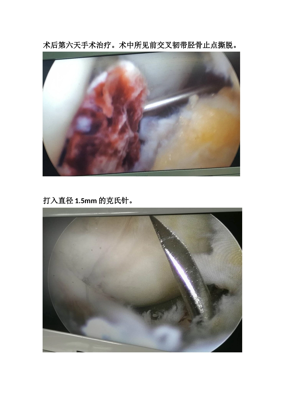 胫骨髁间脊骨折_第11页