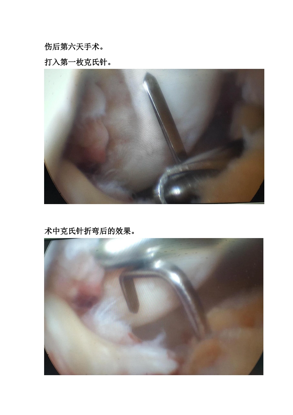 胫骨髁间脊骨折_第7页