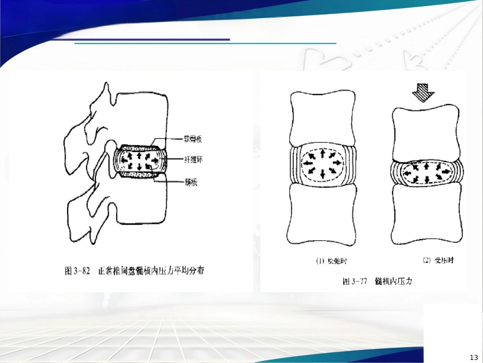 腰椎间盘突出症诊治PPT课件_第13页