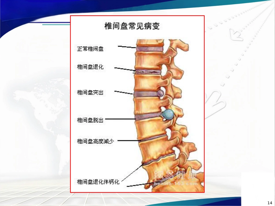 腰椎间盘突出症诊治PPT课件_第14页