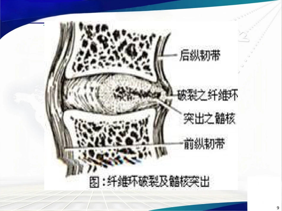 腰椎间盘突出症诊治PPT课件_第9页