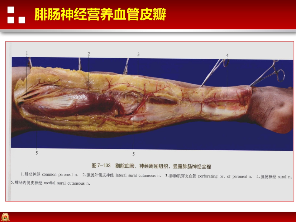 带蒂皮瓣转移修复足踝部创面_第10页