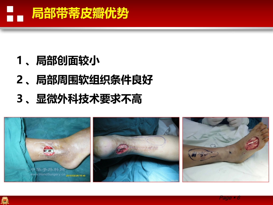带蒂皮瓣转移修复足踝部创面_第6页