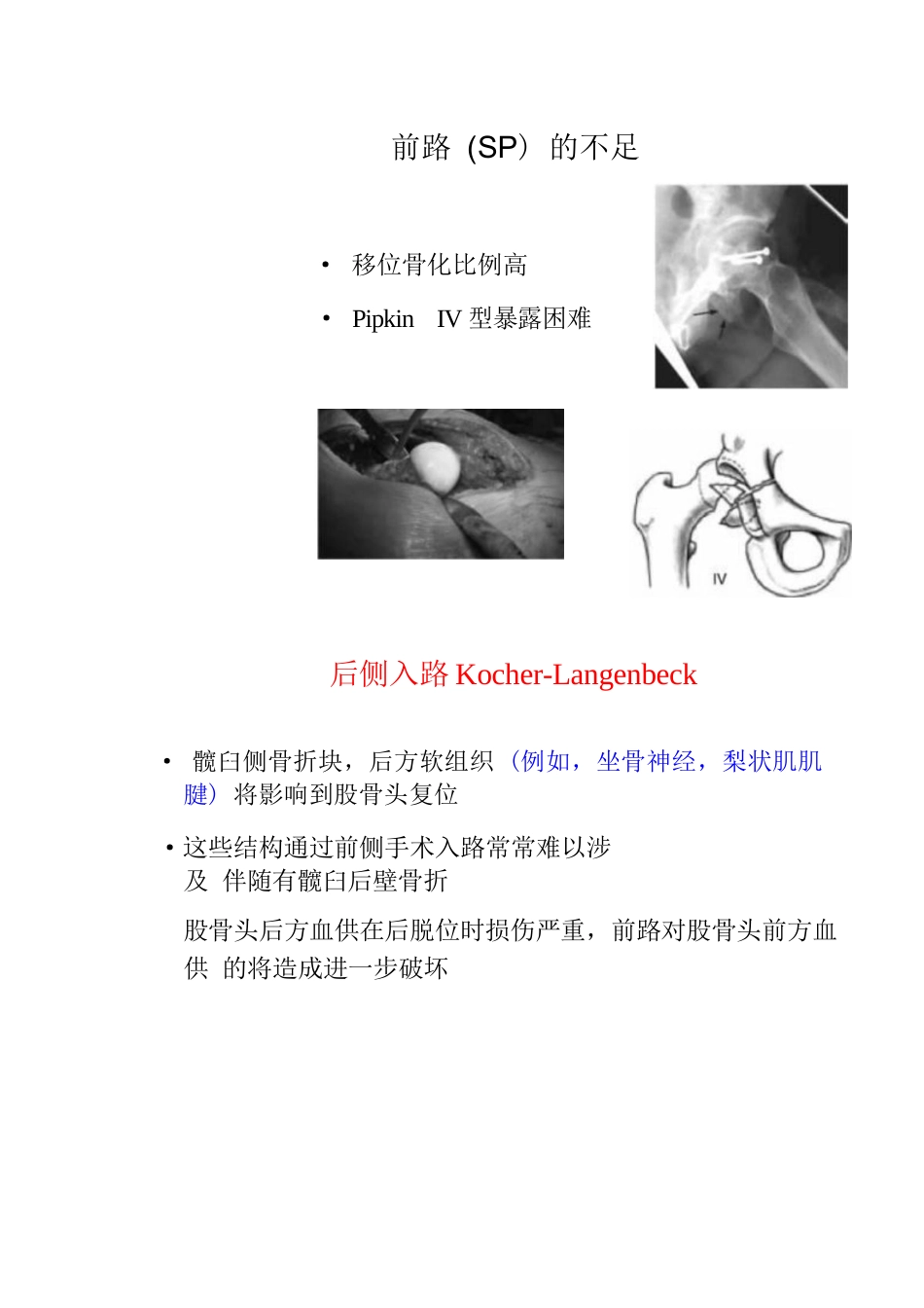 股骨头骨折的手术入路及方法_第11页