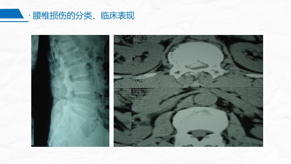 腰椎骨折围手术期护理_第13页