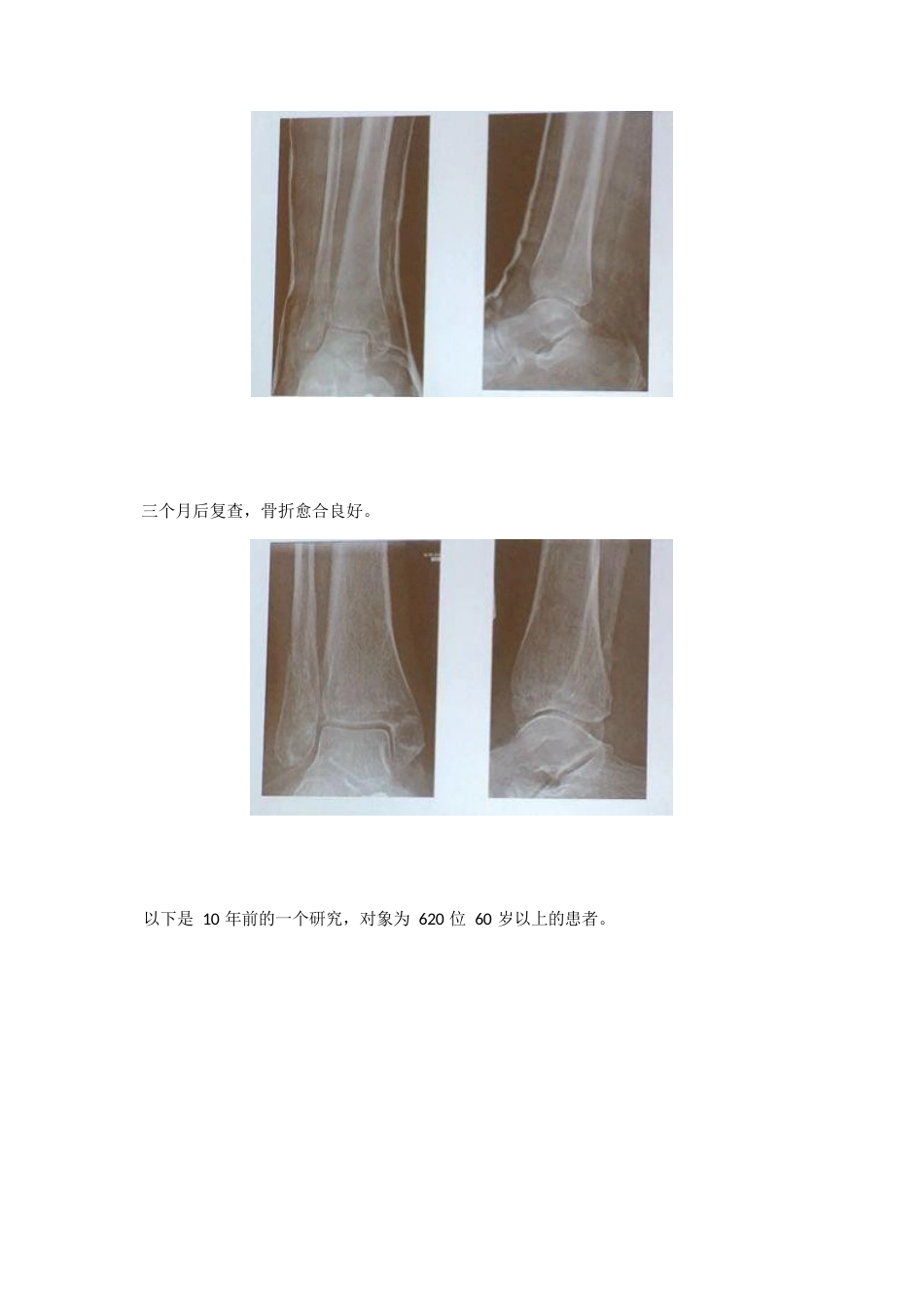 踝关节骨折后到底什么时候负重？_第10页
