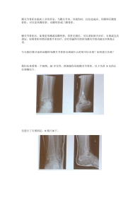 踝关节骨折后到底什么时候负重？