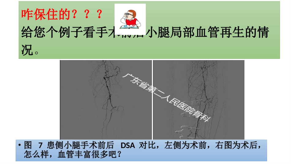 糖尿病足一定要截肢吗？_第10页