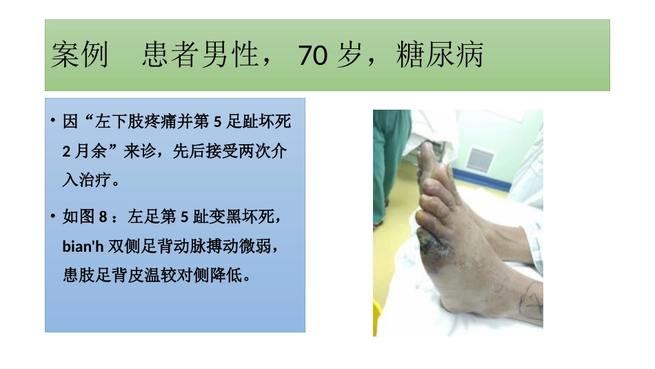 糖尿病足一定要截肢吗？_第12页