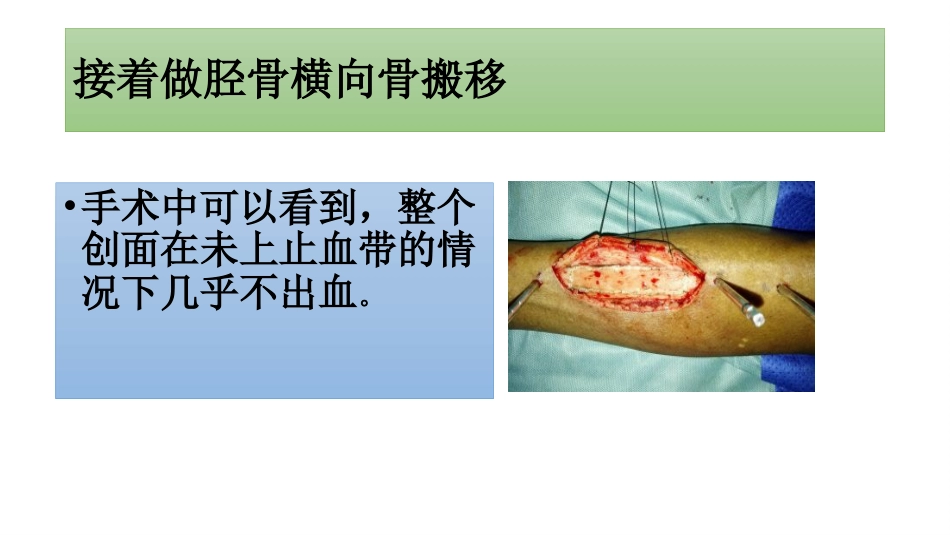 糖尿病足一定要截肢吗？_第13页