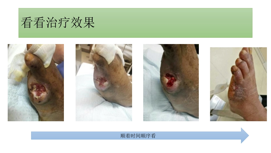 糖尿病足一定要截肢吗？_第14页