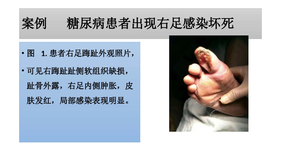 糖尿病足一定要截肢吗？_第3页