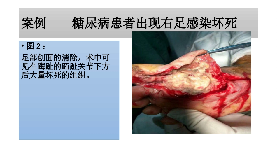 糖尿病足一定要截肢吗？_第4页