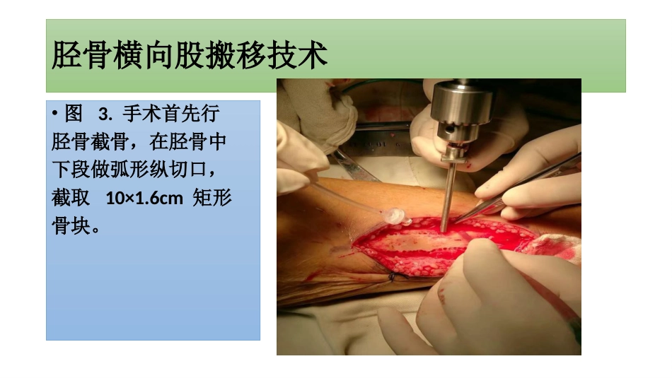糖尿病足一定要截肢吗？_第6页