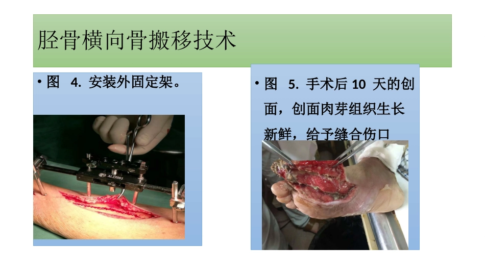 糖尿病足一定要截肢吗？_第7页