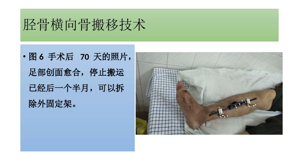 糖尿病足一定要截肢吗？_第8页