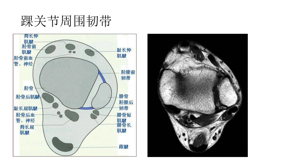 踝关节撞击综合征影像学表现_第10页