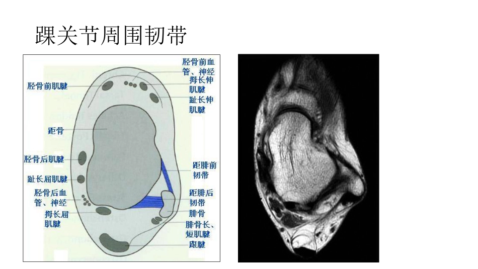 踝关节撞击综合征影像学表现_第11页