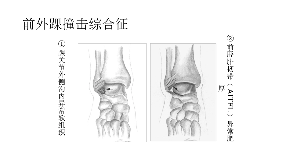 踝关节撞击综合征影像学表现_第13页