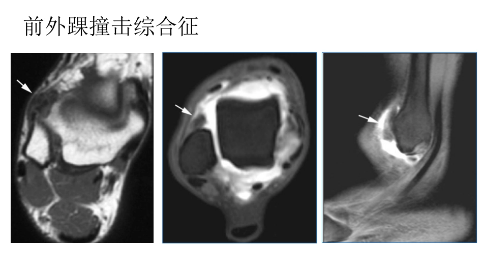 踝关节撞击综合征影像学表现_第14页