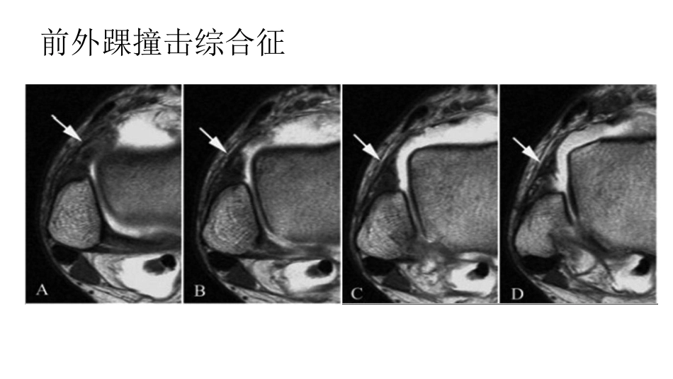 踝关节撞击综合征影像学表现_第15页
