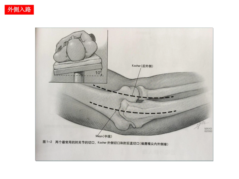 肘关节手术入路_第12页