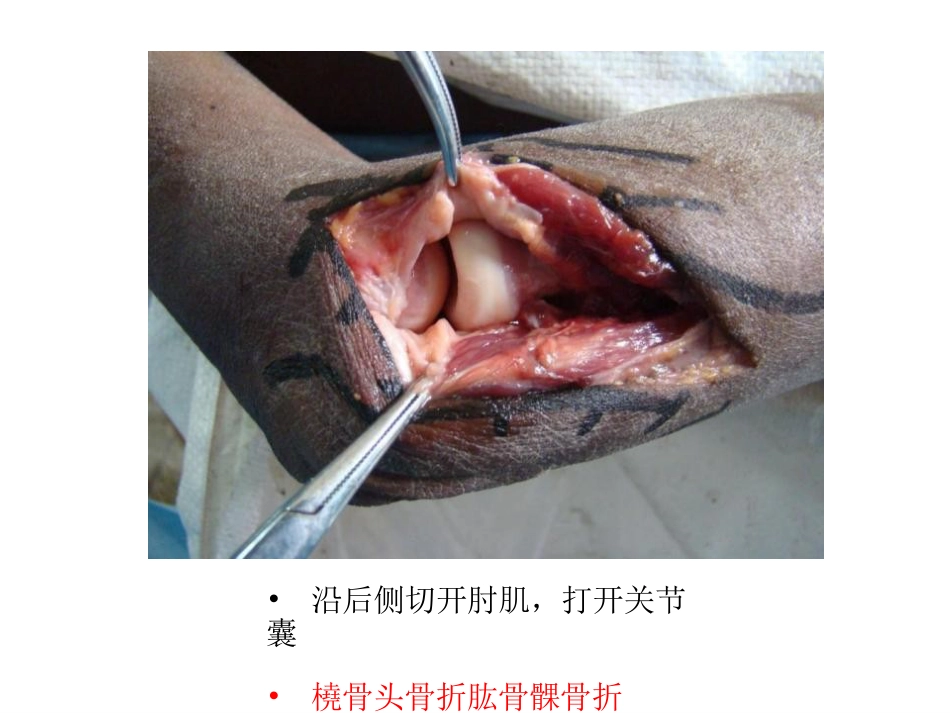 肘关节手术入路_第15页