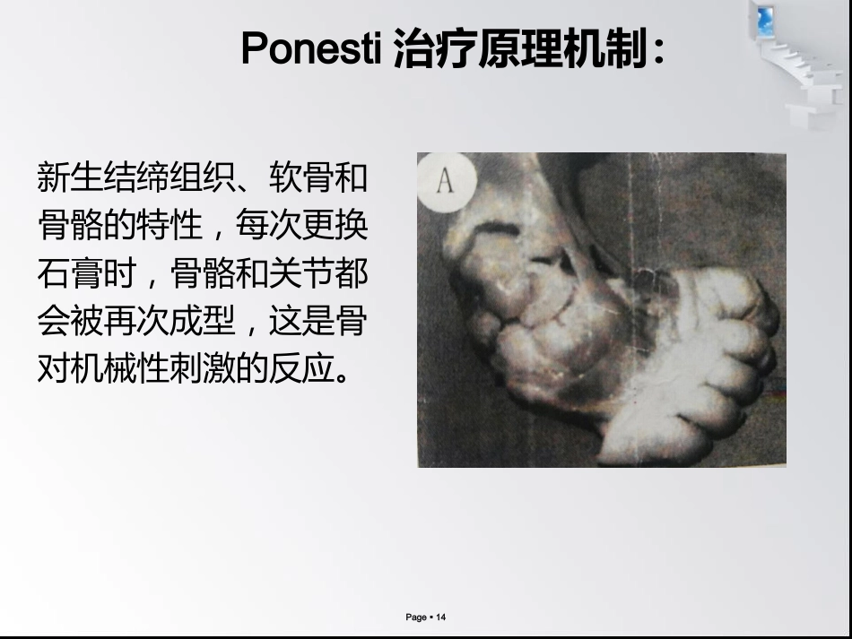 小儿马蹄内翻足_第14页