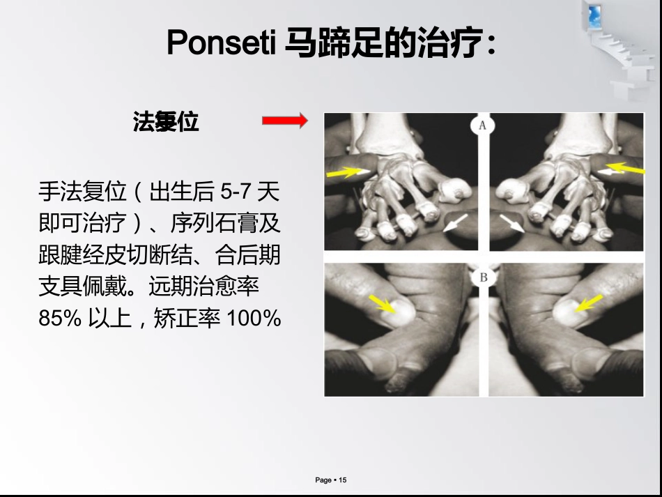 小儿马蹄内翻足_第15页