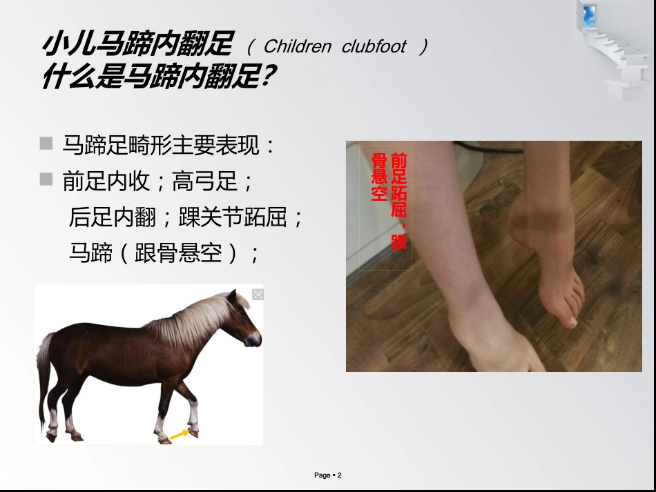 小儿马蹄内翻足_第2页