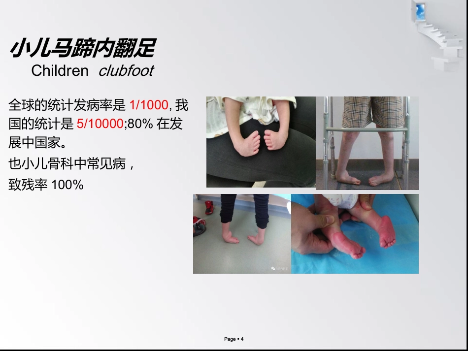 小儿马蹄内翻足_第4页