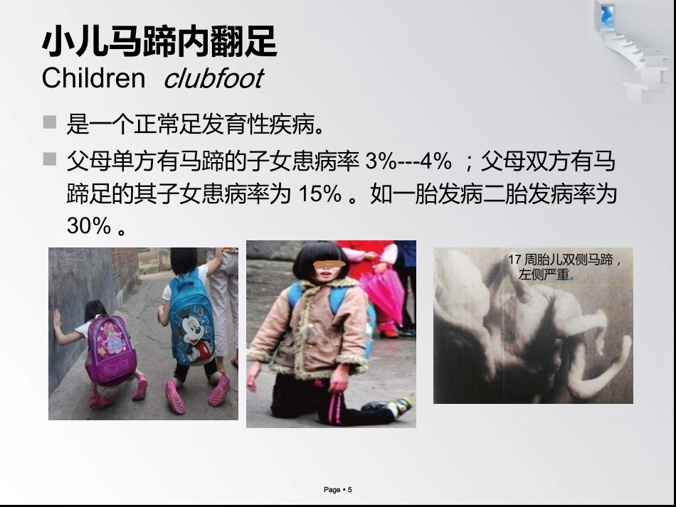 小儿马蹄内翻足_第5页